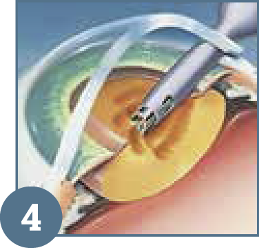 Cirugía con lente intraocular personalizada