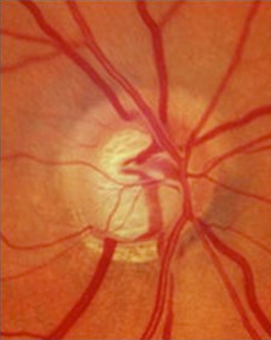  Qué es el glaucoma?