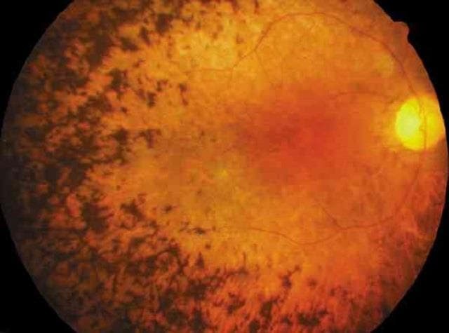 ¿Qué es la retinosis pigmentaria y cómo se trata?