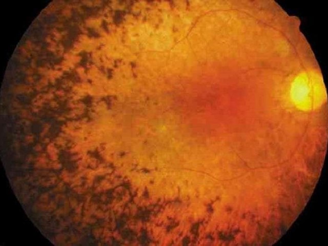 ¿Qué es la retinosis pigmentaria y cómo se trata?
